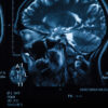 Over 550 Depo-Provera Lawsuits Filed by Women With Meningioma Brain Tumors