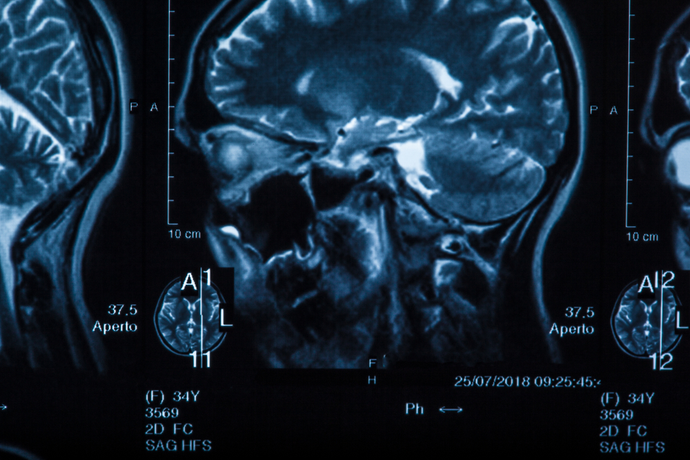 Over 550 Depo-Provera Lawsuits Filed by Women With Meningioma Brain Tumors