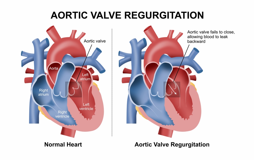 Aortic Valve Regurgitation Trifecta Heart Valve