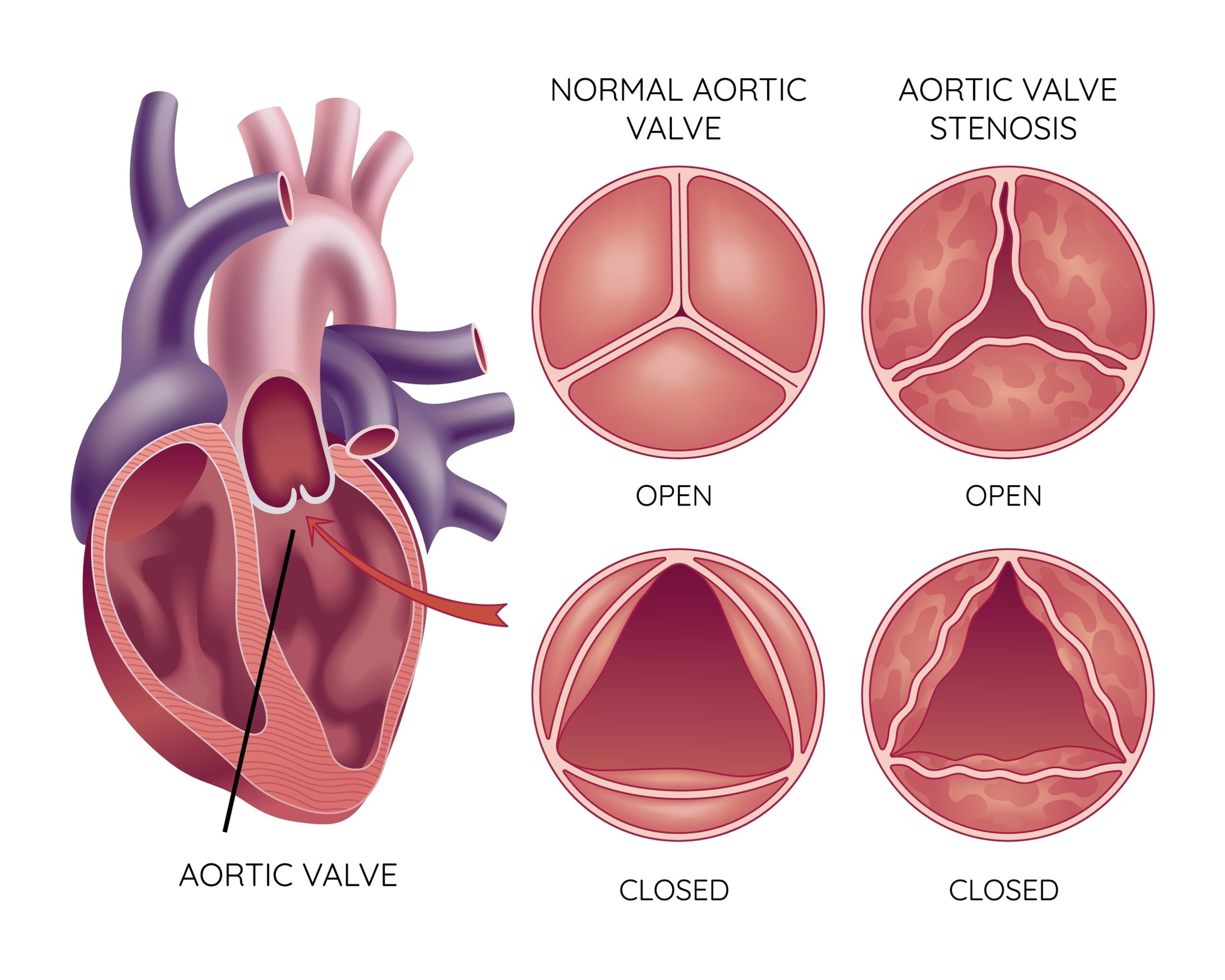 Aortic-Valve-Stenosis-Trifecta-Heart-Valve