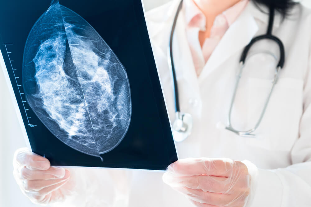 BioZorb-Implant-Lawsuit-Over-Pain-Fracture-Migration-Infection