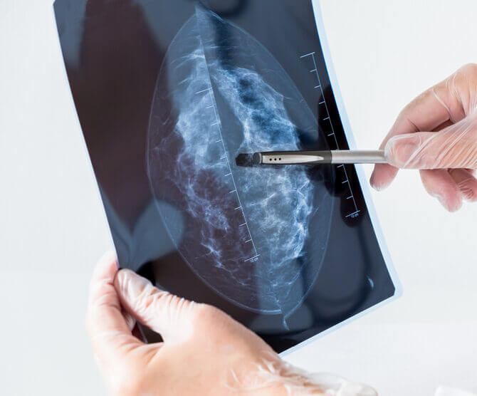 BioZorb Marker Implant Lawsuit