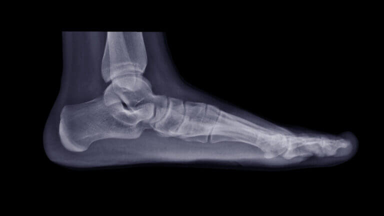 Biomet Phoenix Ankle Nail Lawsuit Alleges System Failed, Fractured Due to Defects