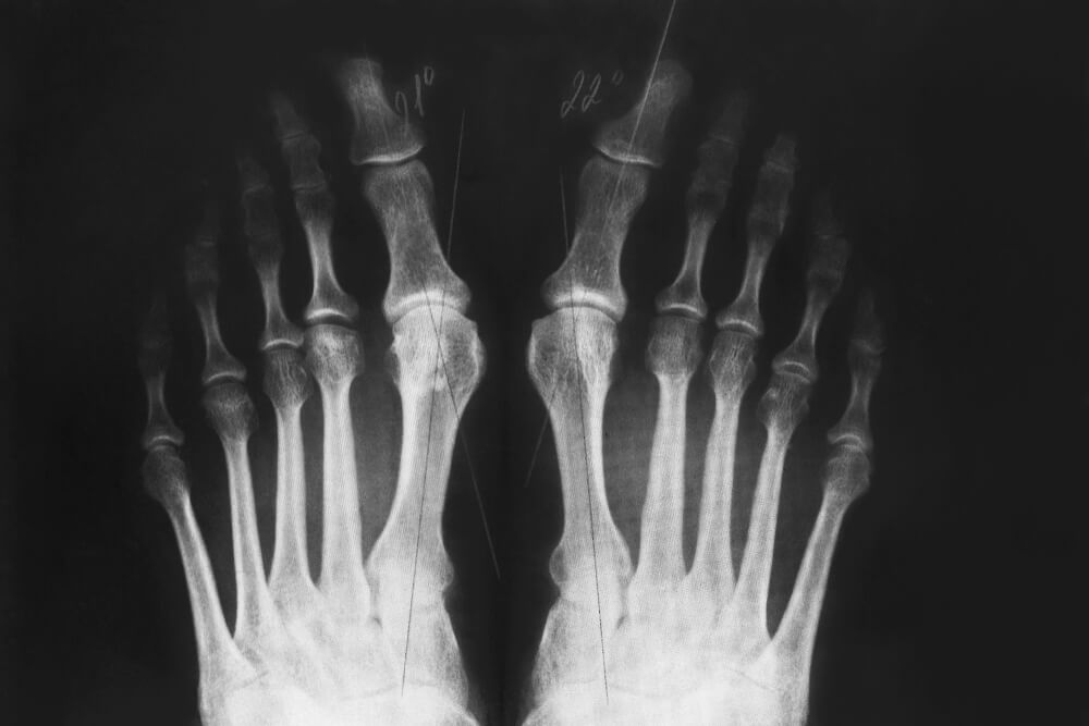 Cartiva Settlement Rumors Mount, As More Toe Implant Lawsuits Withdrawn Shortly After Filed