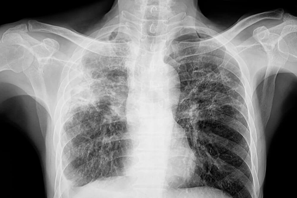 Chest X-Rays May Not Be Enough for Silicosis Diagnosis, Study Warns