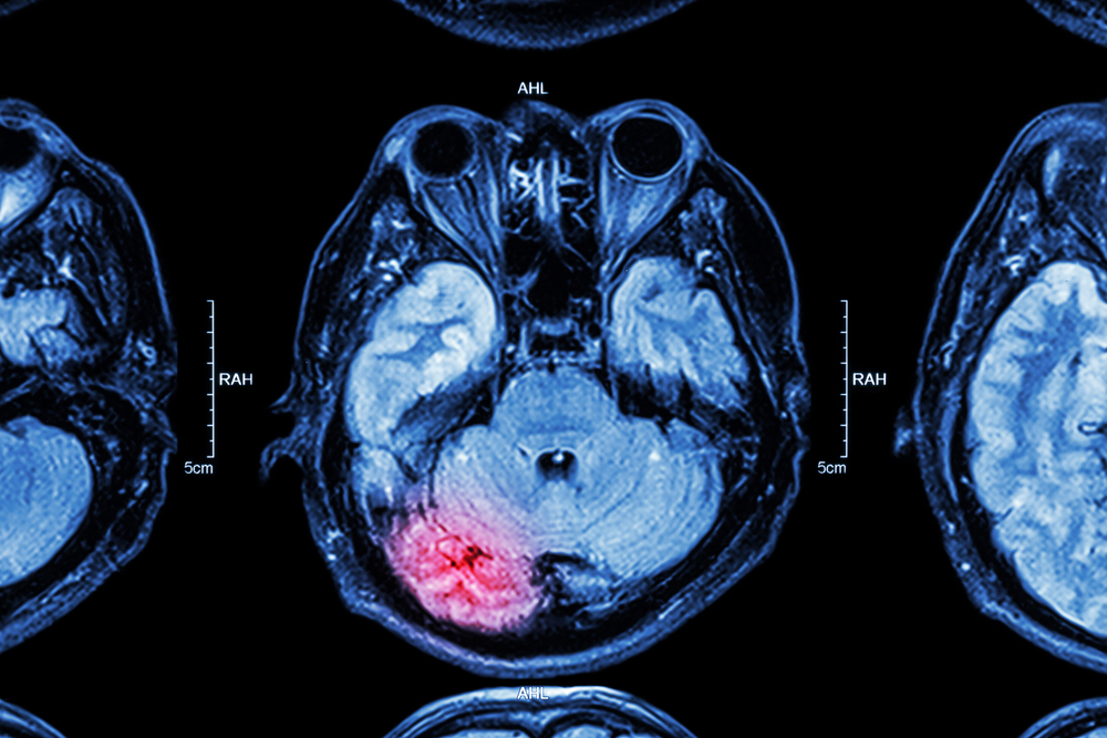 Dementia Risks From Traumatic Brain Injuries Among Older Adults Highlighted in New Study