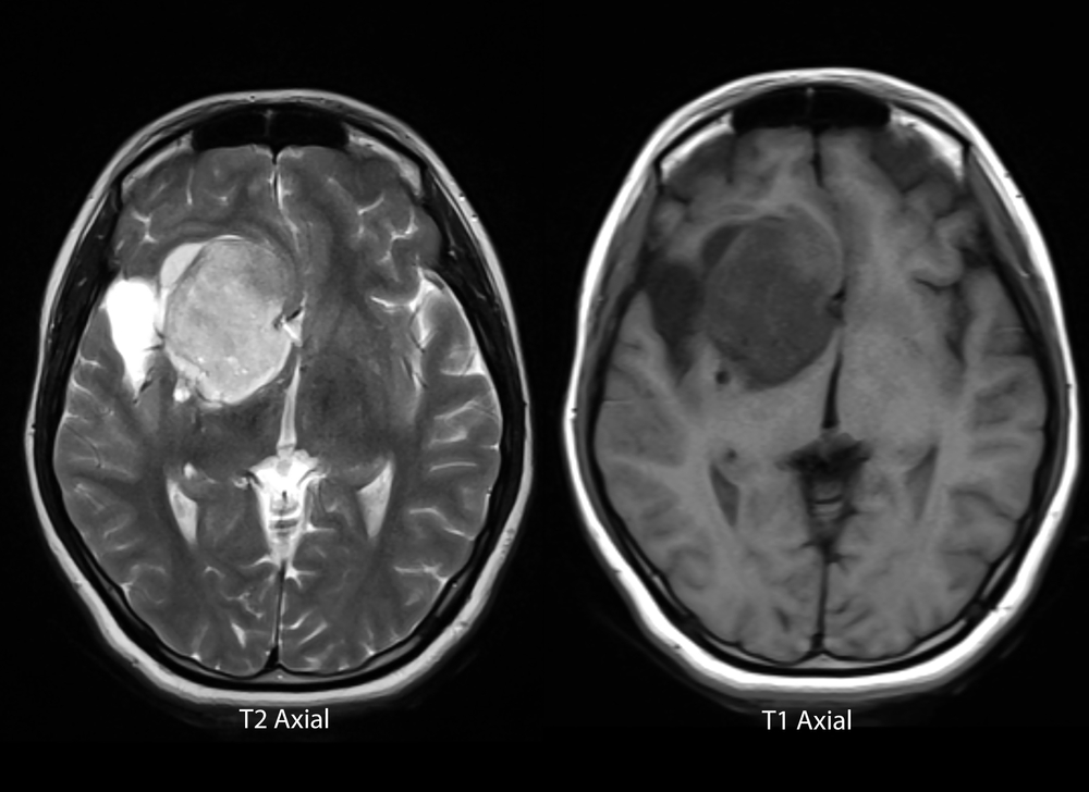 Lawsuit Alleges Depo-Provera Caused Brain Surgery, After Meningioma Diagnosis