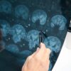 Depo-Provera Brain Tumor Lawsuit Describes Left-Sided Numbness, Tingling Before Diagnosis