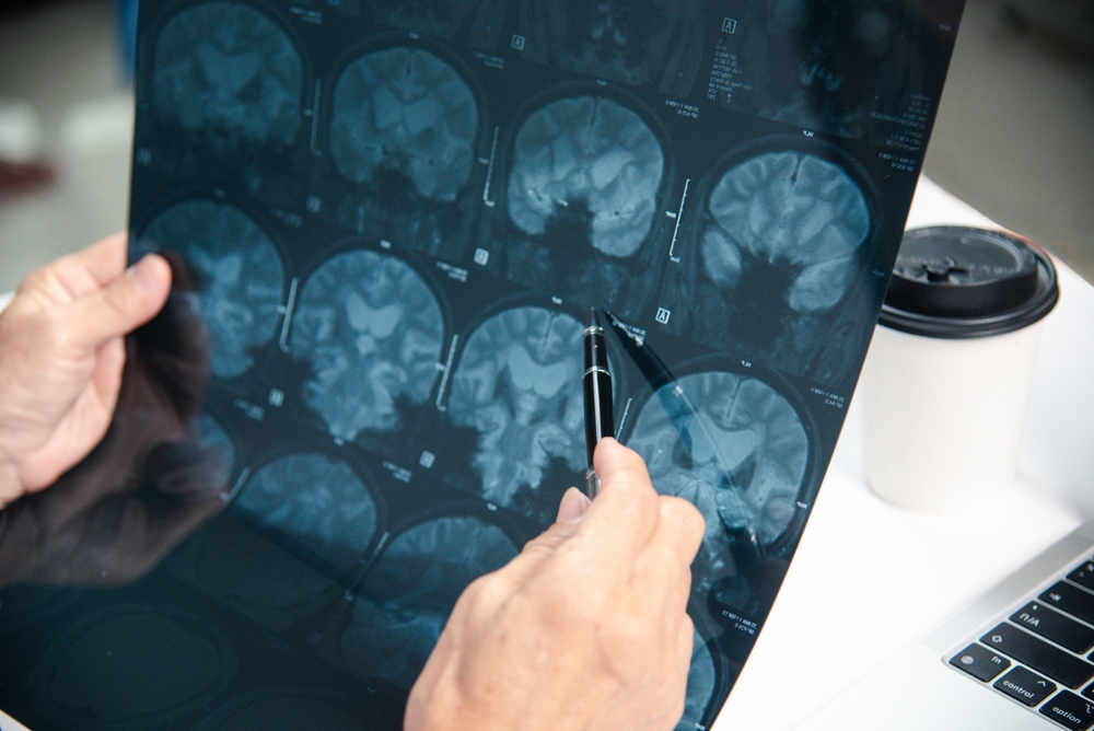 Depo-Provera Brain Tumor Lawsuit Describes Left-Sided Numbness, Tingling Before Diagnosis