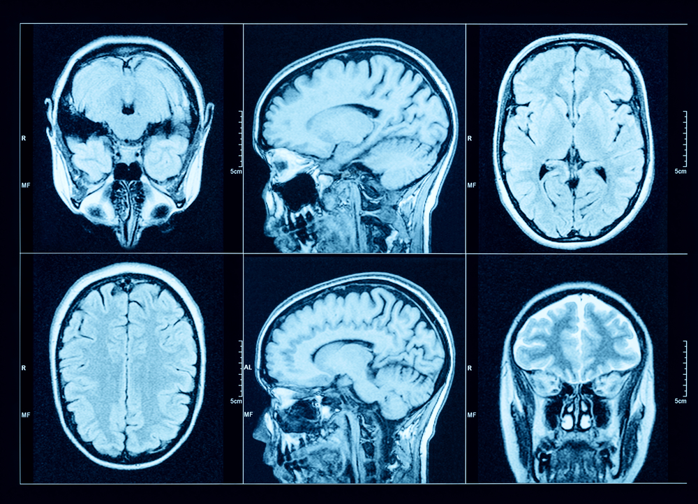 Depo-Provera Brain Tumor Caused Numbness Over Half of Woman's Body, Lawsuit Alleges