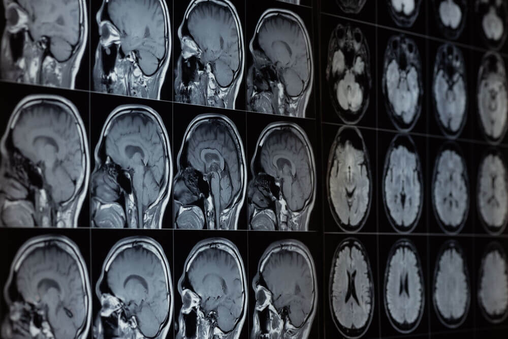 Depo-Provera Shot Lawsuit Filed Over Brain Tumor That Required Surgical Removal and Radiation Treatments