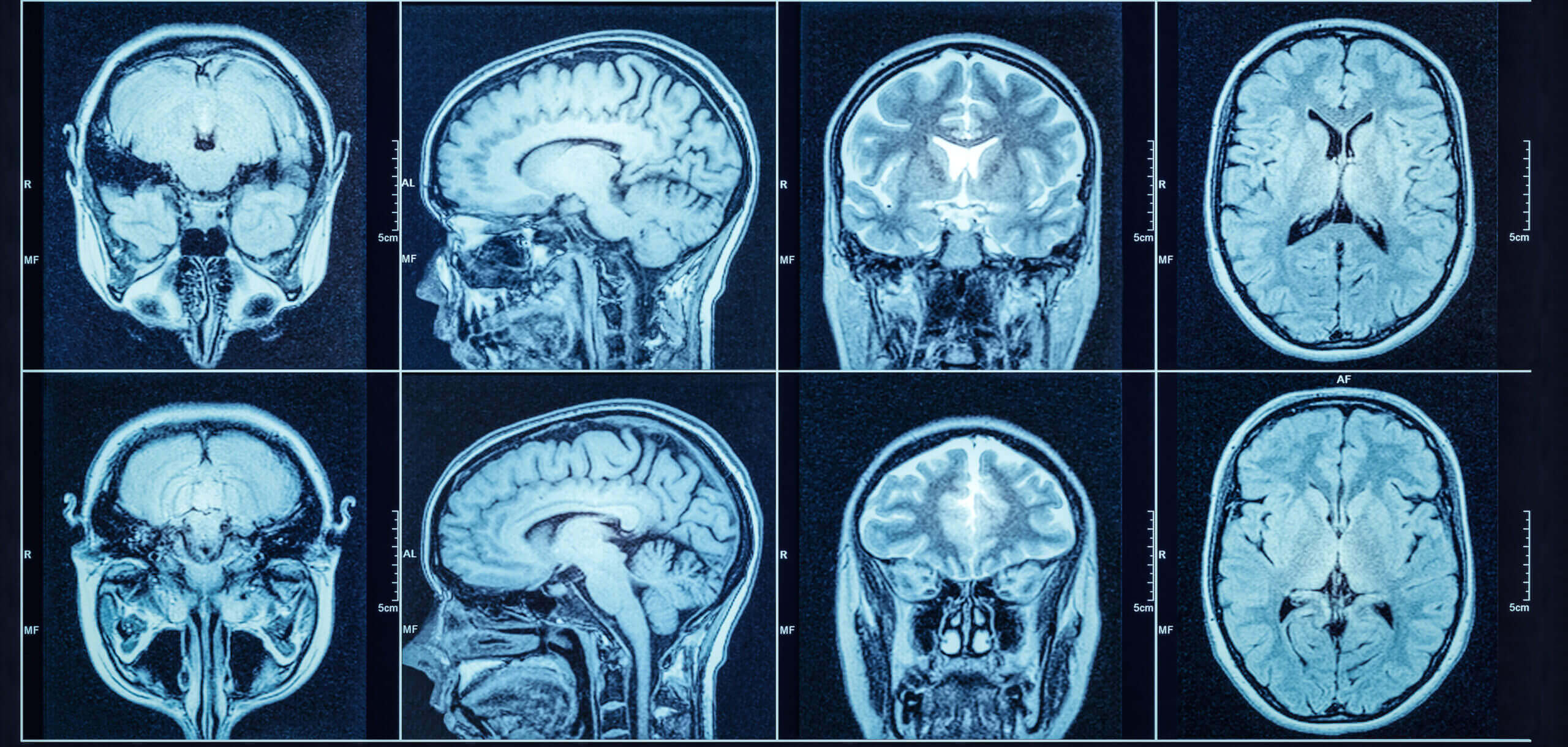 Woman Files Depo-Provera Meningioma Lawsuit After Needing Brain Surgery, Annual MRIs