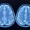 Depo-Provera Meningioma Side Effects Left Woman With Debilitating Migraines, Lawsuit Claims