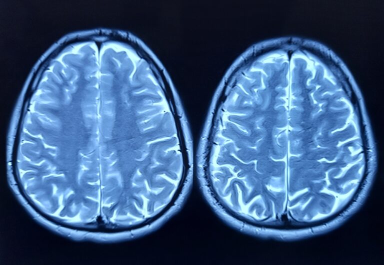 Depo-Provera Meningioma Side Effects Left Woman With Debilitating Migraines, Lawsuit Claims