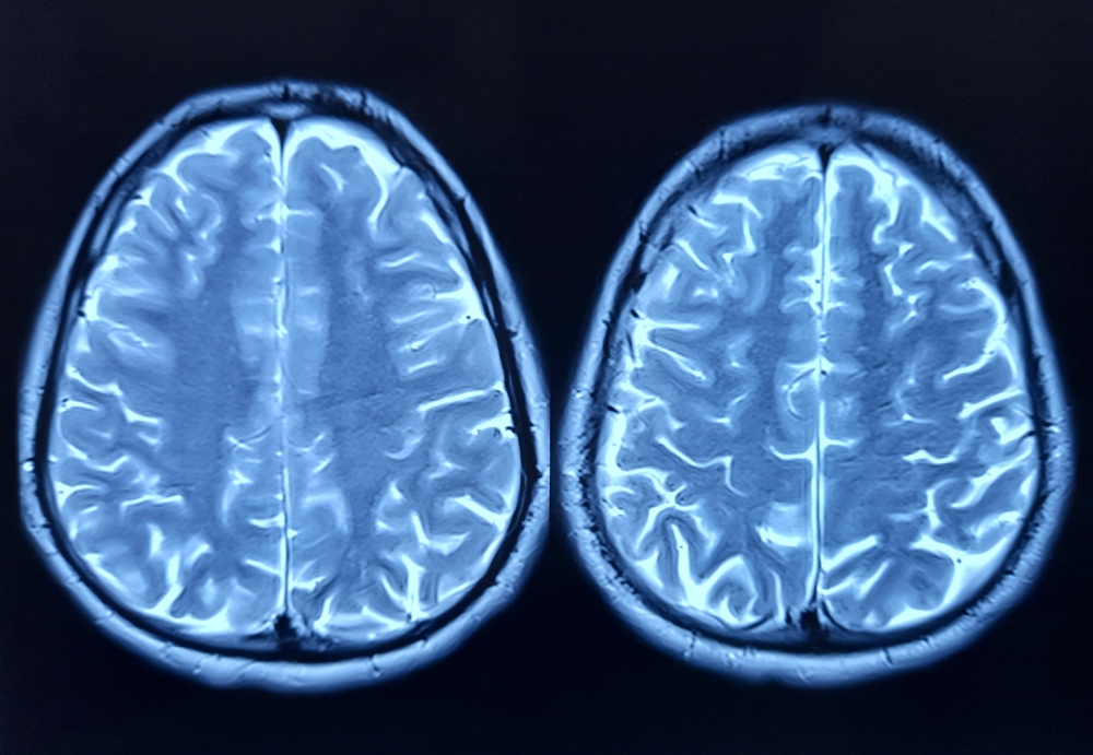 Depo-Provera Meningioma Side Effects Left Woman With Debilitating Migraines, Lawsuit Claims