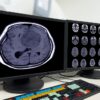 Depo-Provera Meningioma Side Effects Significantly Increased Among Women Over 31 Study
