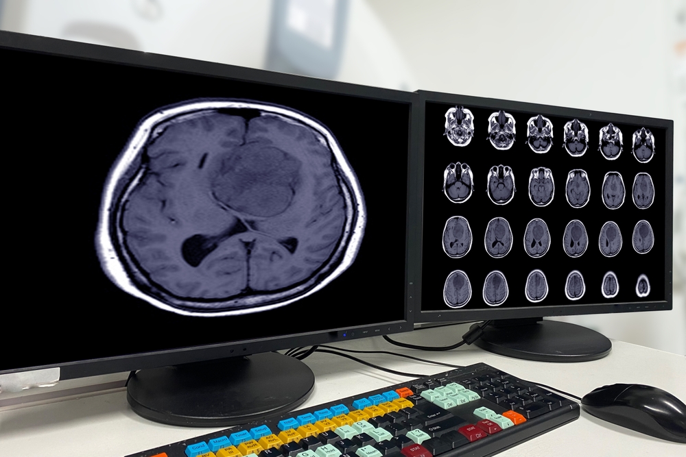 Depo-Provera Meningioma Side Effects Significantly Increased Among Women Over 31 Study
