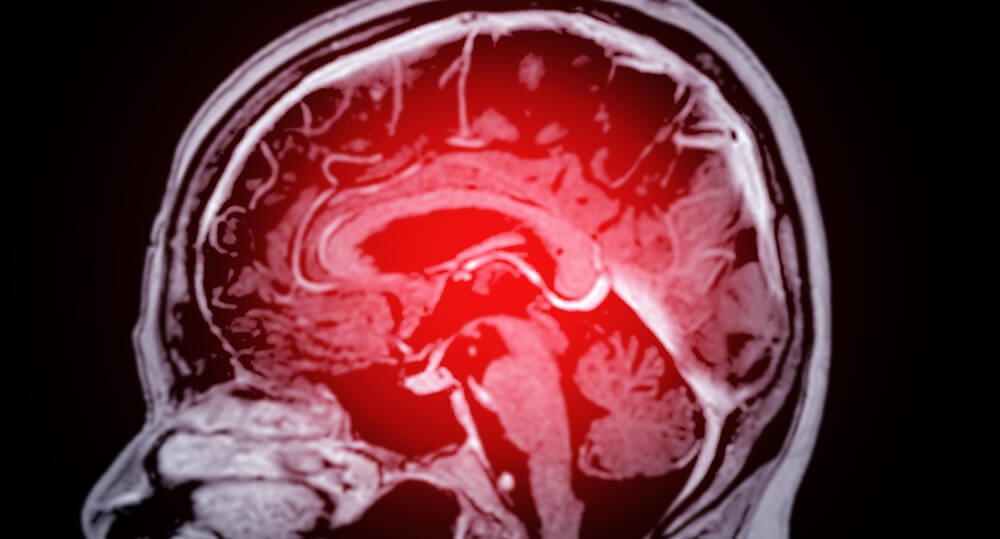 Eisai Never Told Patients in Leqembi Clinical Trials They Faced Higher Risk of Brain Bleeds NYT
