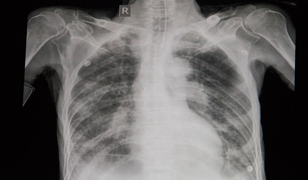 Fabricated Stone Workers May Face Risk of New Lung Disease Silicosarcoidosis