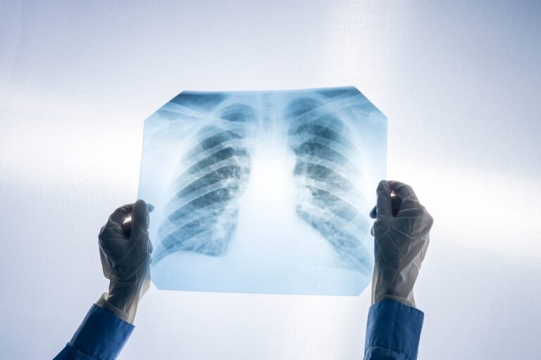Hundreds of Silicosis Cases Diagnosed Among Quartz Countertop Workers in California Report