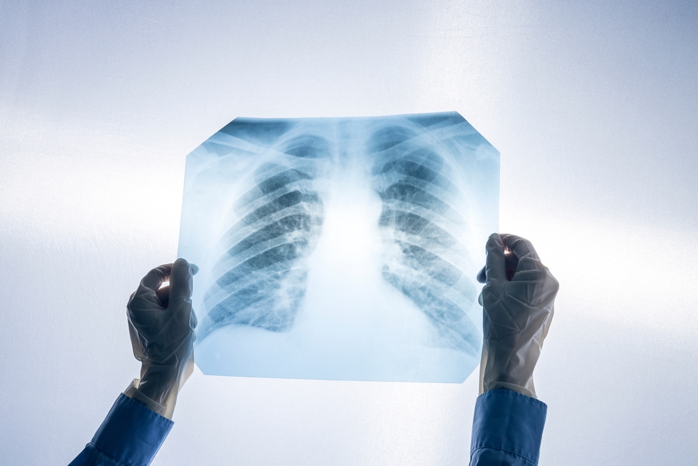 Hundreds of Silicosis Cases Diagnosed Among Quartz Countertop Workers in California Report
