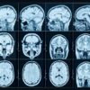 Intracranial Meningioma From Depo-Provera Shots Caused Hearing Loss, Vision Loss: Lawsuit