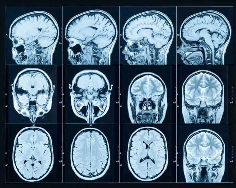 Intracranial Meningioma From Depo-Provera Shots Caused Hearing Loss, Vision Loss: Lawsuit
