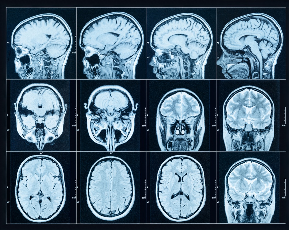 Intracranial Meningioma From Depo-Provera Shots Caused Hearing Loss, Vision Loss: Lawsuit