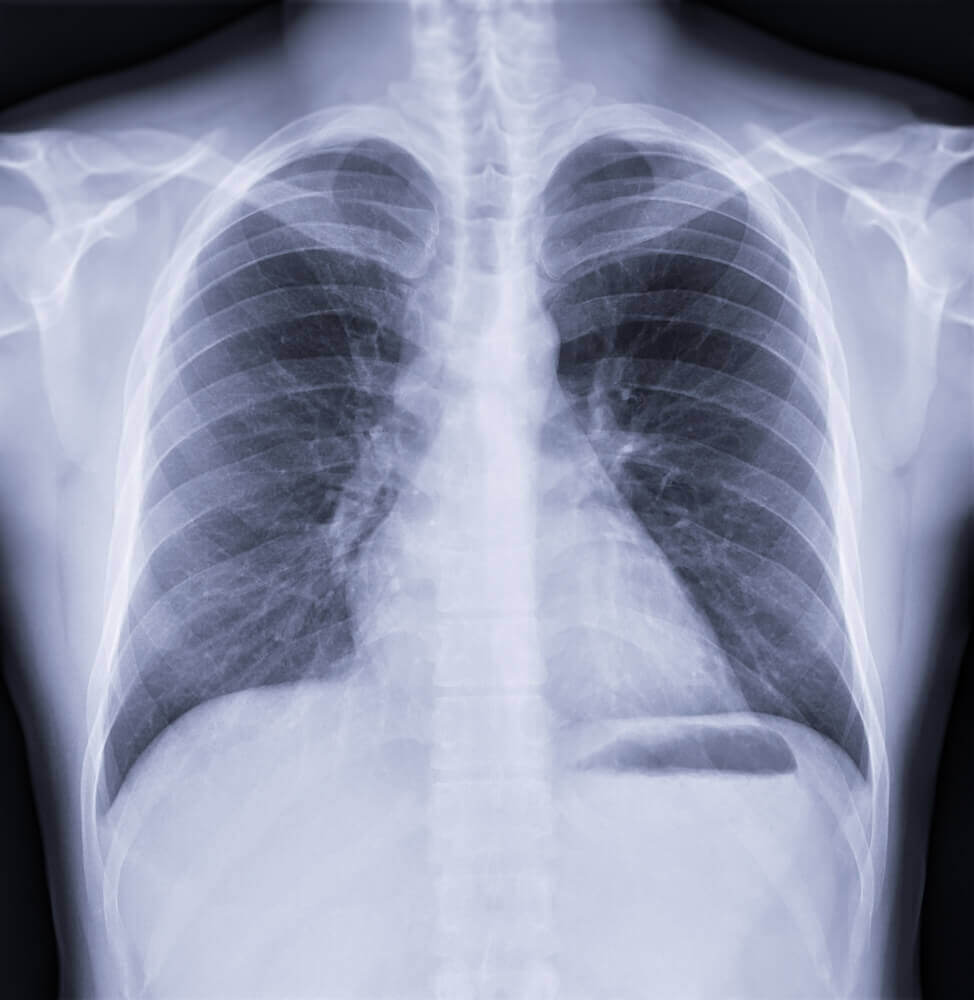 Keytruda, Similar Cancer Drugs May Increase Risk of Pulmonary Embolism Study