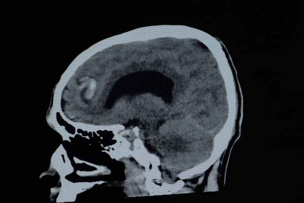 Eli Lilly Kisunla Brain Swelling Side Effects Reduced Modified Dosing Schedule