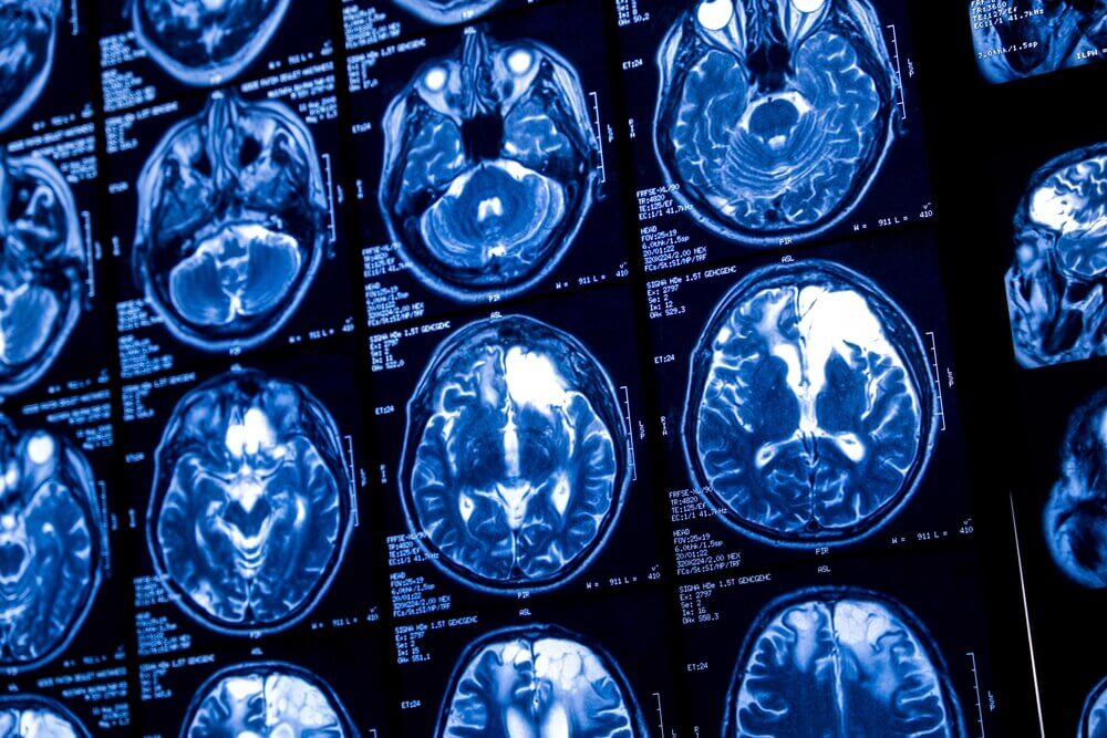 Lawsuit Alleges Depo-Provera Caused Intracranial Meningioma Brain Tumors