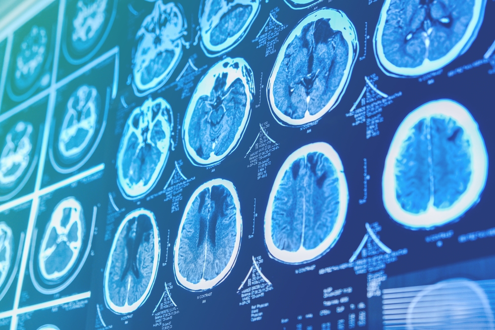 Lawsuit Alleges Depo-Provera Neurological Symptoms Were Result of Meningioma