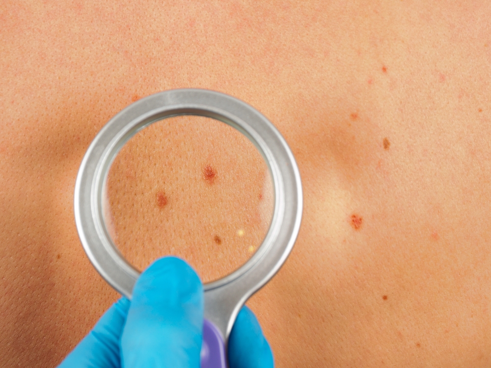 Living Near Farmland May Increase Risk of Melanoma Skin Cancer Study