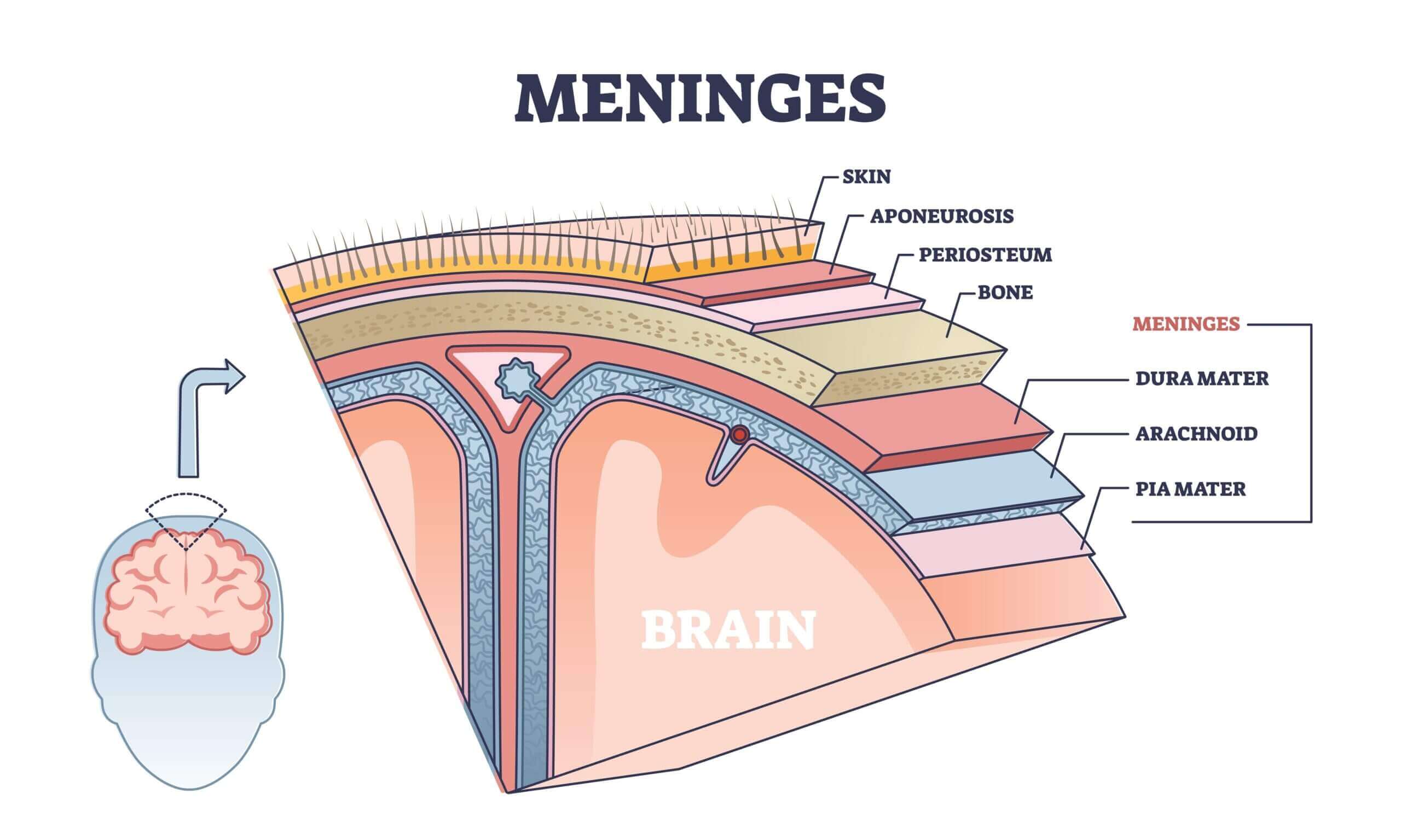 Lawsuits Over Depo-Provera meningiomas 