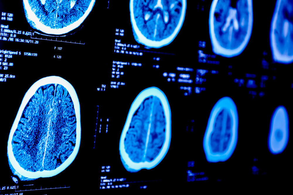 Meningioma Lawsuit Filed Against Depo-Provera Shot Manufacturers Over Failure To Warn About Brain Tumors