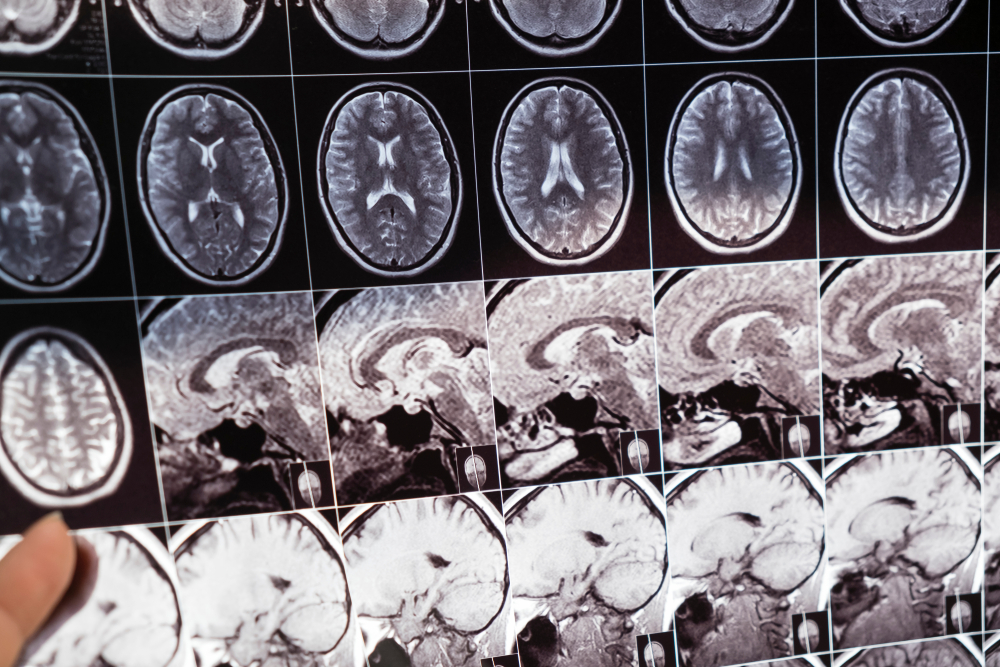 Microplastics in the Brain Could Trigger Alzheimer's Disease Symptoms Study