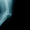 Misha Knee System Lawsuit Alleges Defective Implant Required Second Surgery