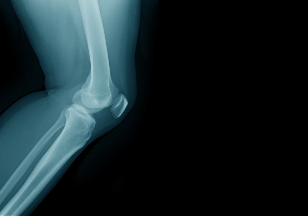Misha Knee System Lawsuit Alleges Defective Implant Required Second Surgery