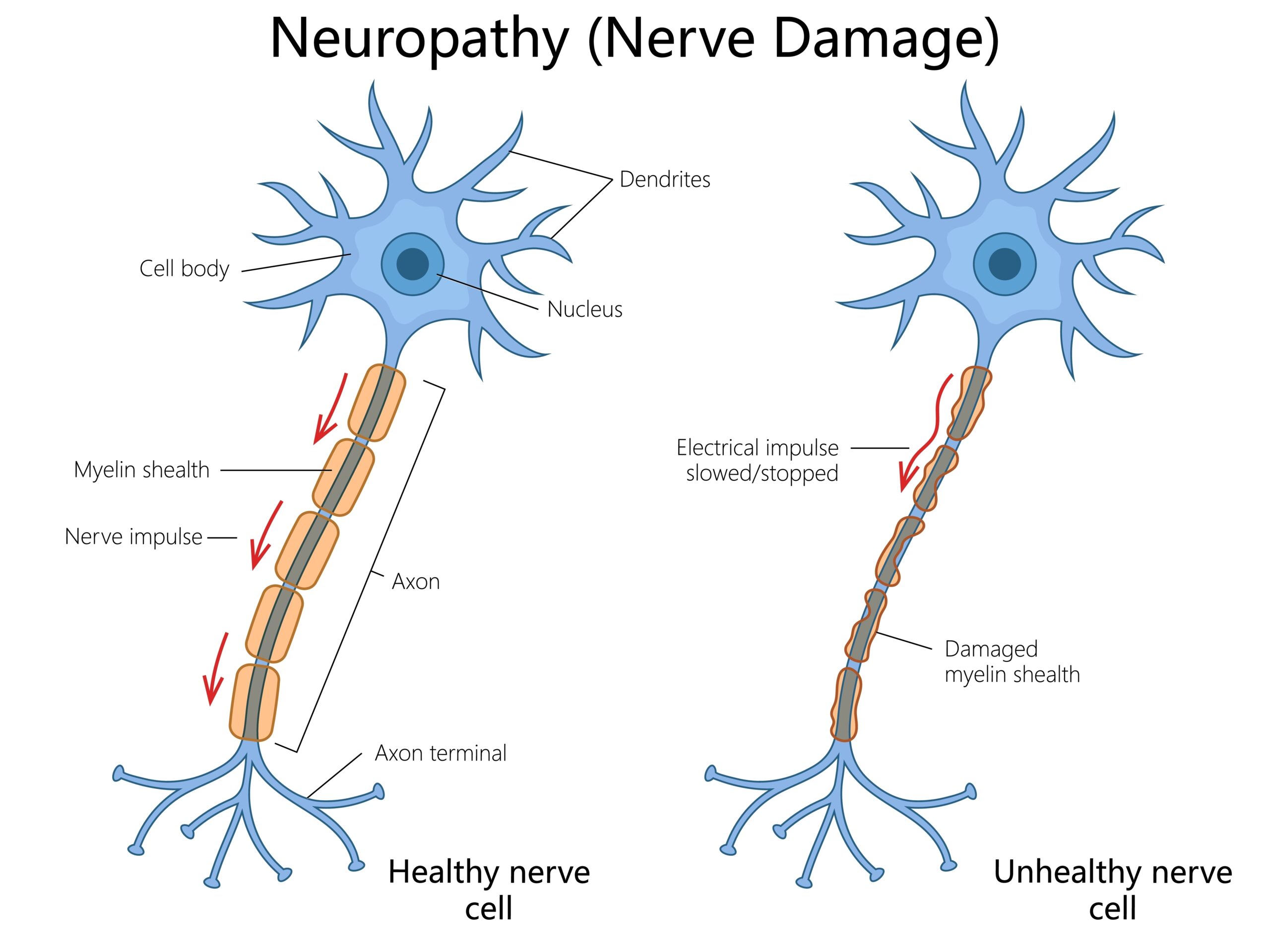 Nitrous Oxide Nerve Damage