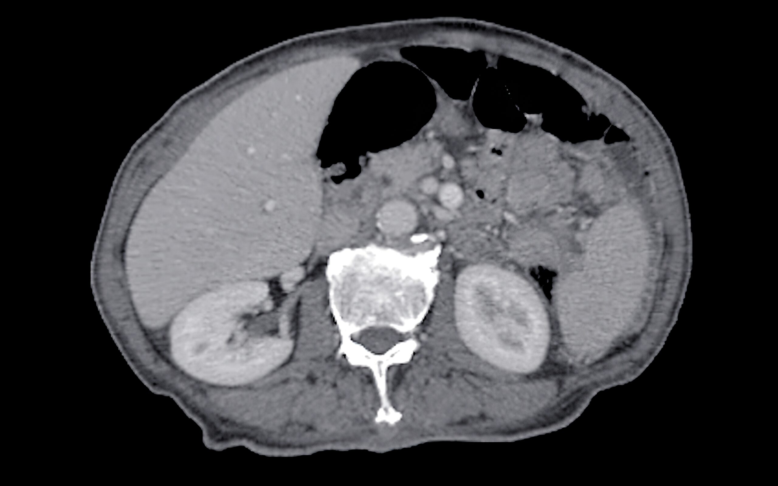 Ocaliva Lawsuits Over Failure To Warn About Liver Injury Problems May Follow Market Withdrawal