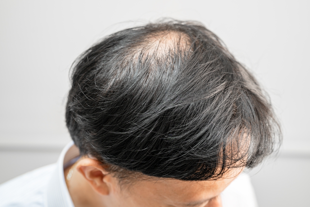 Study Raises New Questions Over Ozempic Hair Loss Risks