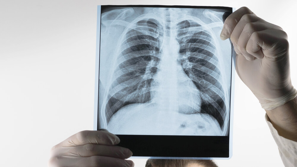 Ozempic Users Face Increased Risk of Lung Complications After Digestive Tract Exams: Study