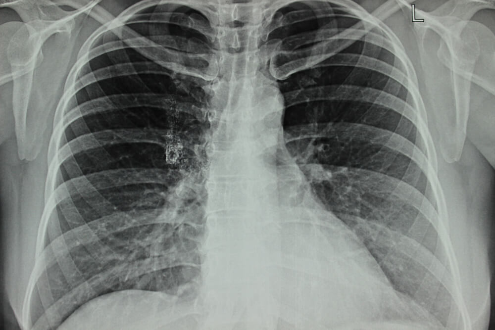 Silica Dust Exposure Lawsuit Filed by Artificial Stone Cutter Left With Severe Lung Damage