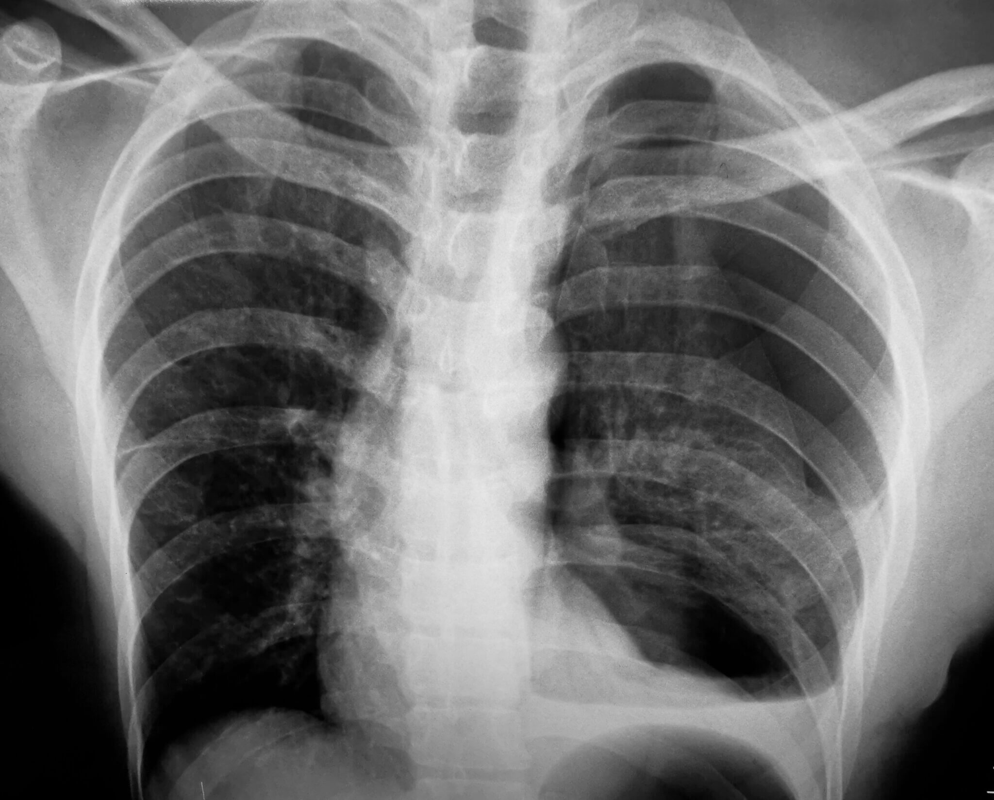Lawsuit Alleges Silicosis Diagnosis Caused by Toxic Dust From ...
