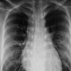 Silicosis Lung Injuries Drive California Push to Ban of Artificial Stone Countertops