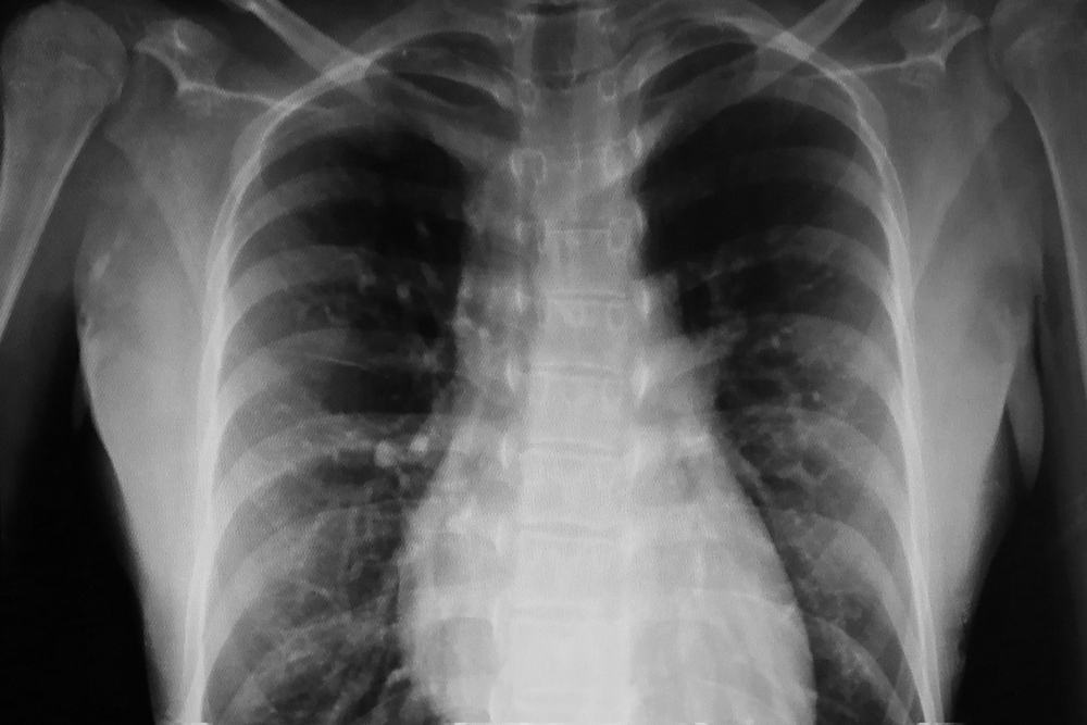 Silicosis Lung Injuries Drive California Push to Ban of Artificial Stone Countertops