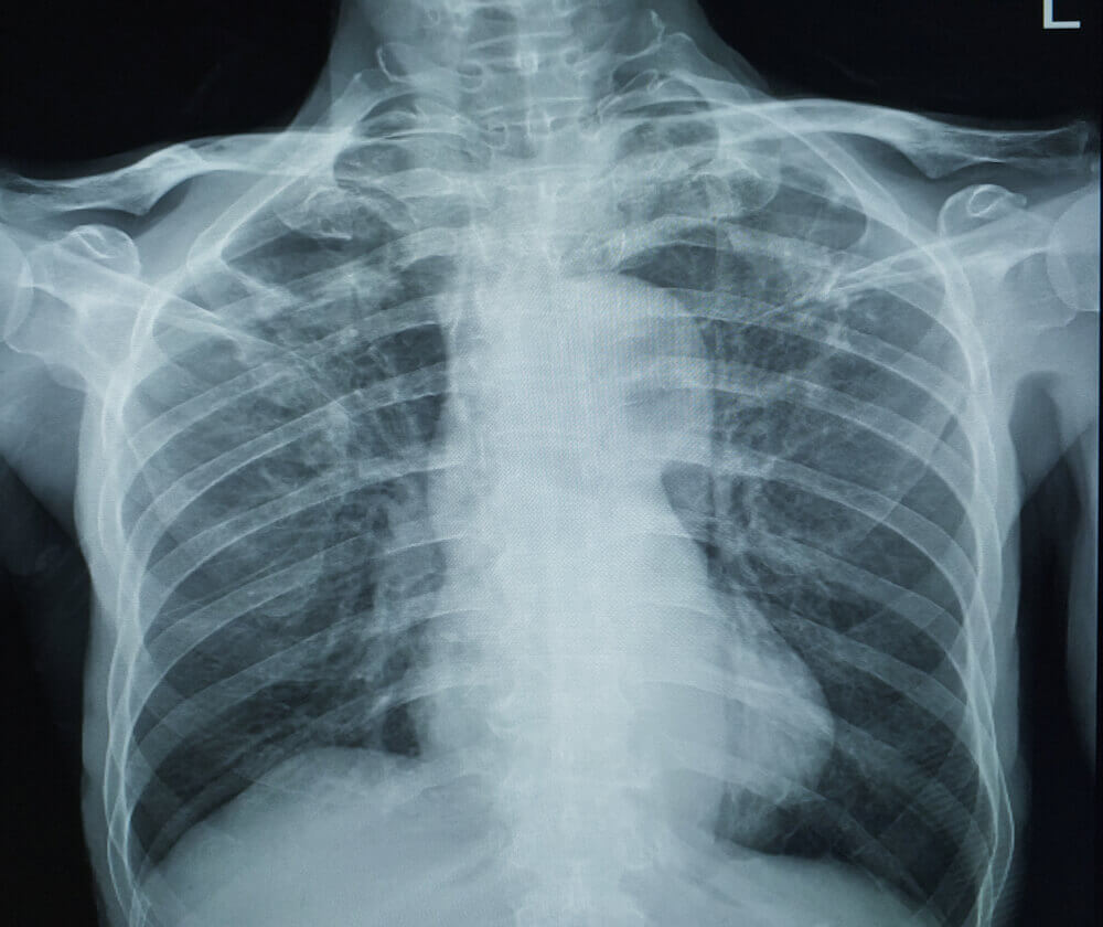 Silicosis Lung Transplant Lawsuit Filed By Former Stone Cutter, Countertop Installer