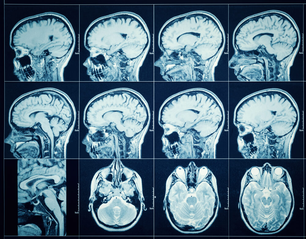 Silicosis Side Effects May Include Cognitive Decline, Study Warns