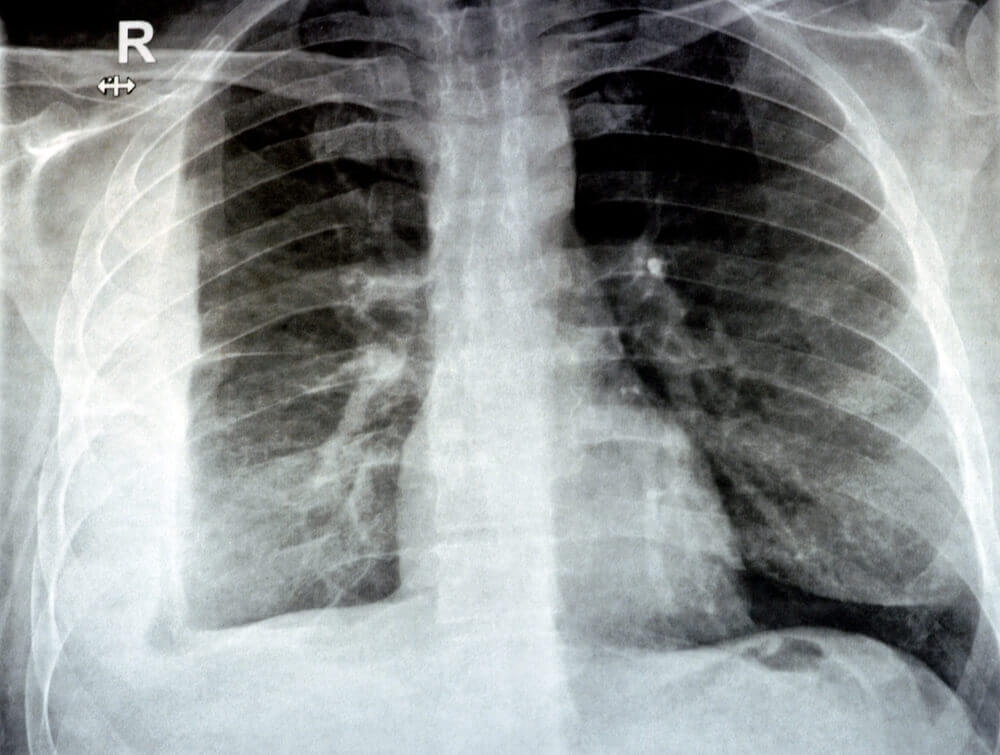 Silicosis from Quartz Countertops Poses Devastating Risks for Workers Cutting Engineered Stone