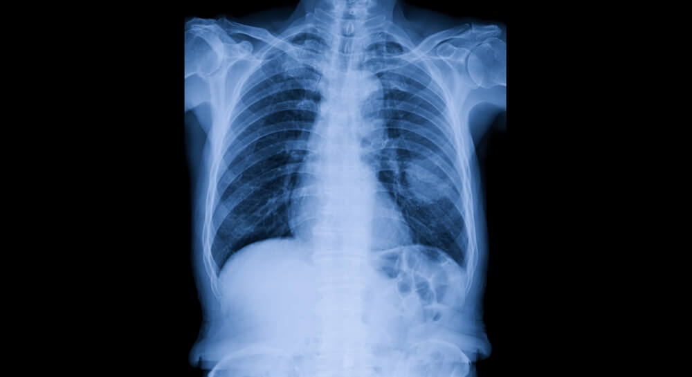 Stone Cutter’s Lawsuit Alleges Lung Disease, Silicosis Warnings Should Have Been Provided